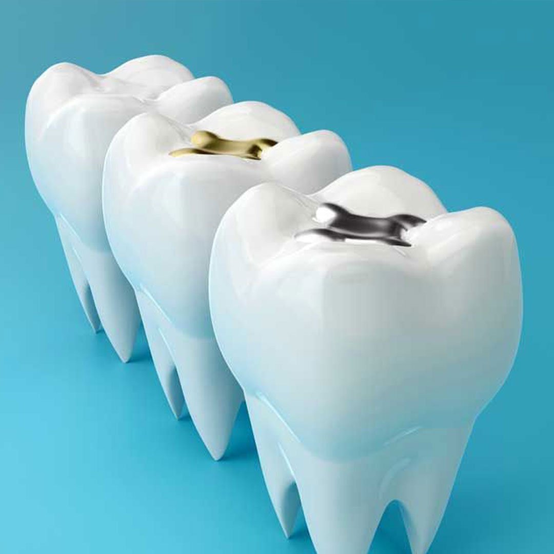 A close-up of a painless cavity repair at Altavista Dental, a Vista-based no-cost dental provider.