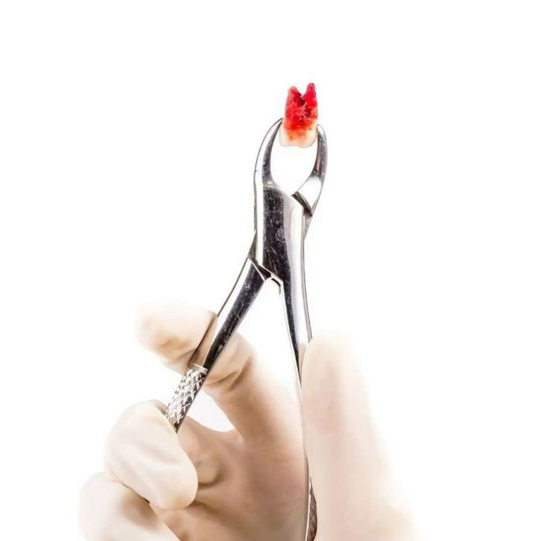 Immediate pain relief via emergency tooth extraction at a Vista office where Medi-Cal is accepted.