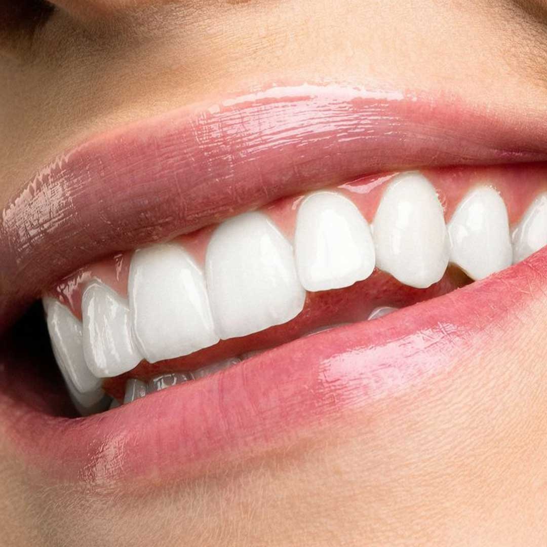 A patient showcasing bright results after receiving professional teeth whitening services in Vista, CA at Alta Vista Dental.